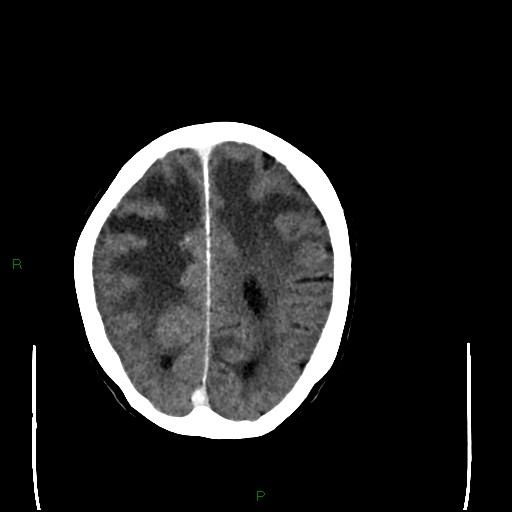Cerebral metastases - breast primary (Radiopaedia 77653-89857 Axial C+ delayed 84).jpg
