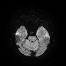 Cerebral metastases - melanoma (Radiopaedia 80972-94522 Axial DWI 43).jpg