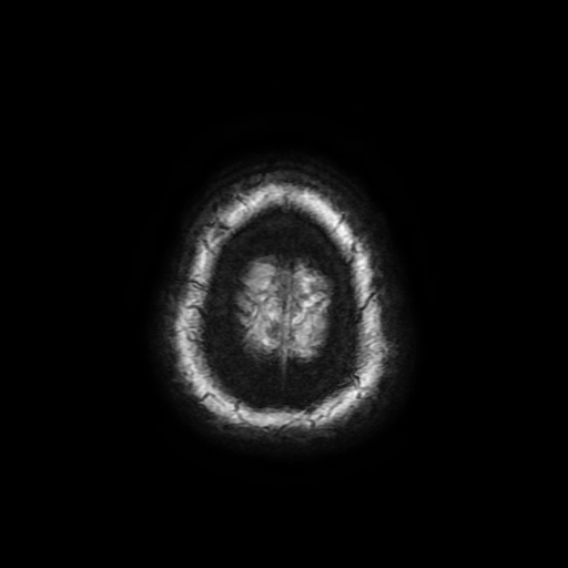 Cerebral metastases - melanoma (Radiopaedia 80972-94522 Axial SWI 97).jpg