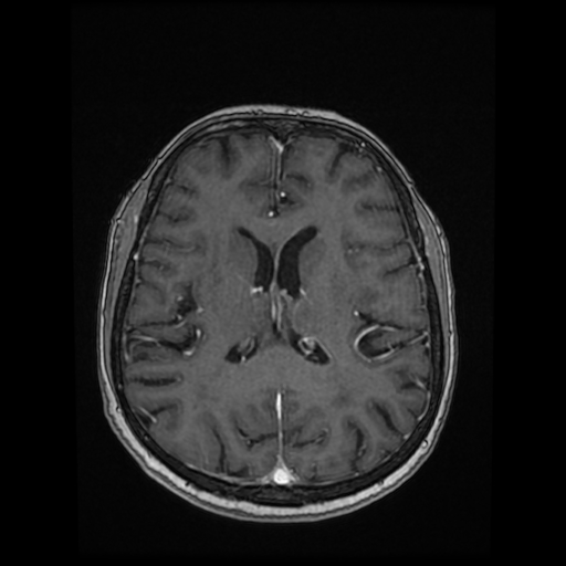Cerebral metastases - melanoma (Radiopaedia 80972-94522 Axial T1 C+ 60).jpg