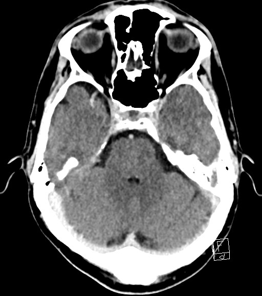 Cerebral metastases - testicular choriocarcinoma (Radiopaedia 84486-99855 Axial C+ delayed 39).jpg