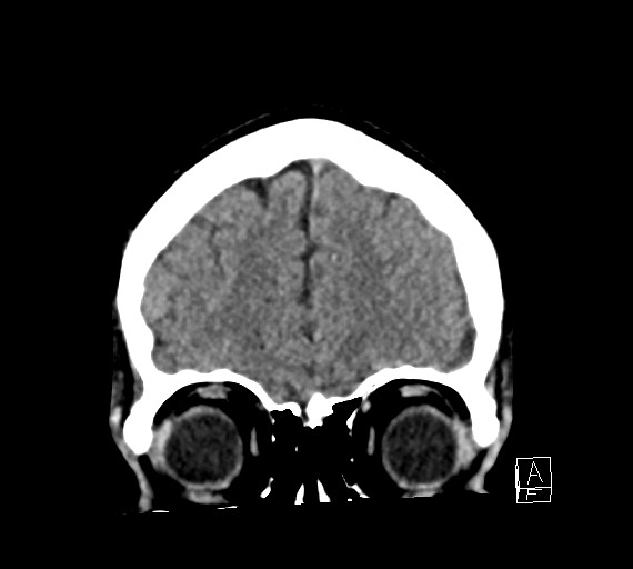 Cerebral metastases - testicular choriocarcinoma (Radiopaedia 84486-99855 Coronal C+ delayed 13).jpg