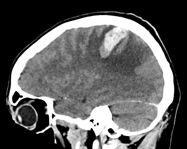 Cerebral metastases - testicular choriocarcinoma (Radiopaedia 84486-99855 F 19).jpg
