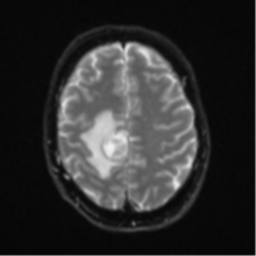 Cerebral metastasis - colorectal adenocarcinoma (Radiopaedia 50394-55765 Axial DWI 21).png