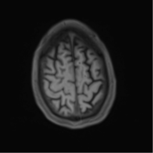 Cerebral metastasis - melanoma (Radiopaedia 54718-60954 Axial T1 45).png
