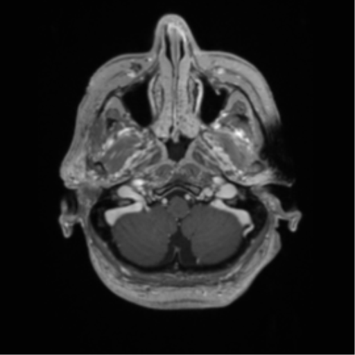 Cerebral metastasis to basal ganglia (Radiopaedia 81568-95413 Axial T1 C+ 8).png