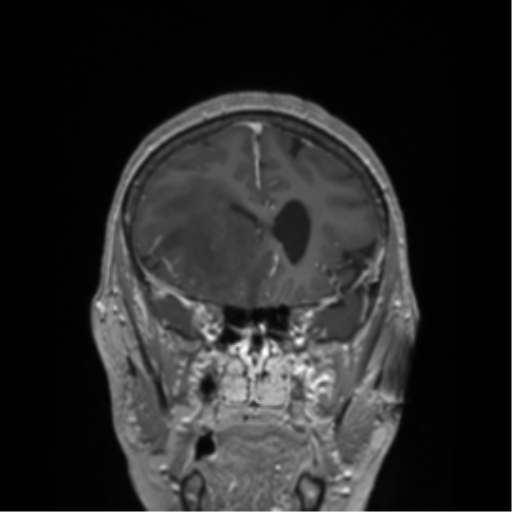 File:Cerebral metastasis to basal ganglia (Radiopaedia 81568-95413 Coronal T1 C+ 44).png