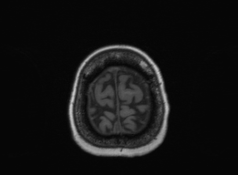 Cerebral ring enhancing lesions - cerebral metastases (Radiopaedia 44922-48817 Axial T1 115).jpg