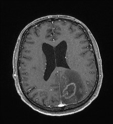 Cerebral toxoplasmosis (Radiopaedia 43956-47461 Axial T1 C+ 47).jpg
