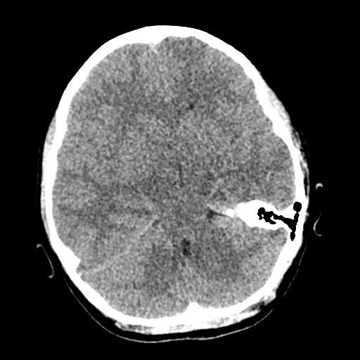 File:Cerebral tuberculosis with dural sinus invasion (Radiopaedia 60353-68018 Axial non-contrast 20).jpg