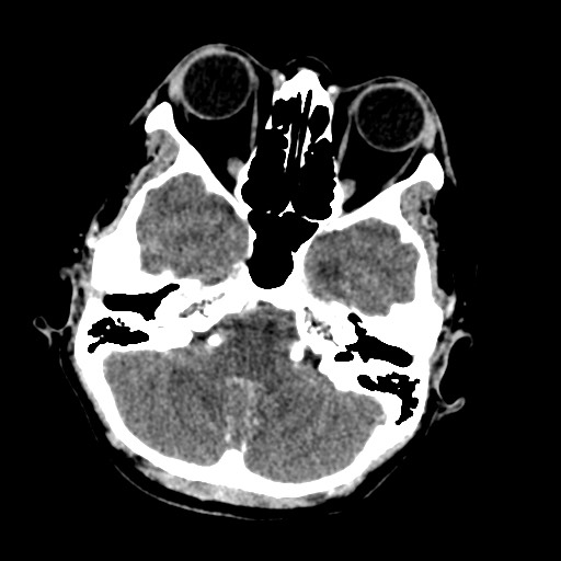 Cerebral tuberculosis with dural sinus invasion (Radiopaedia 60353-68019 Axial C+ delayed 13).jpg