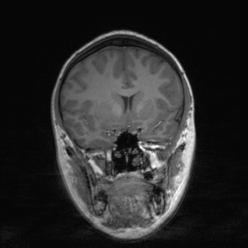 Cerebral tuberculosis with dural sinus invasion (Radiopaedia 60353-68090 Coronal T1 75).jpg