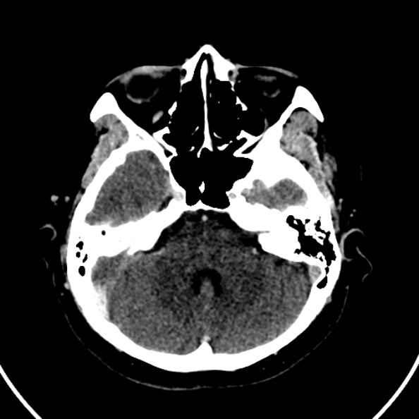 Cerebral venous hemorrhagic infarct from venous sinus thrombosis (Radiopaedia 55433-61883 Axial C+ delayed 111).jpg