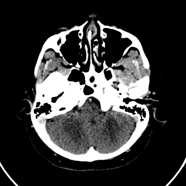 Cerebral venous hemorrhagic infarct from venous sinus thrombosis (Radiopaedia 55433-61883 Axial C+ delayed 120).jpg