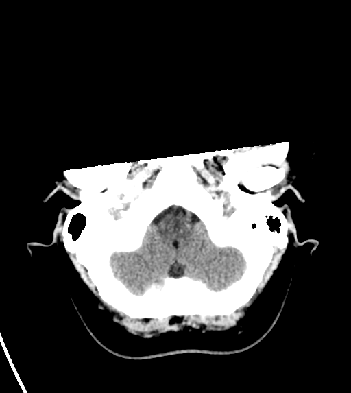 File:Cerebral venous infarct related to dural venous sinus thromboses (Radiopaedia 35292-36804 Axial non-contrast 5).png