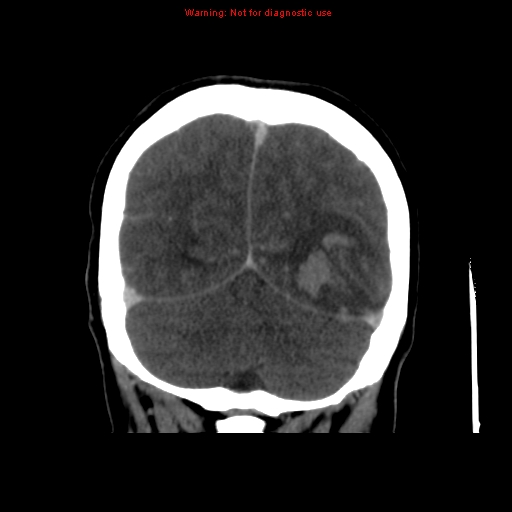 Cerebral venous infarction (Radiopaedia 12404-20735 B 65).jpg
