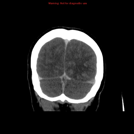Cerebral venous infarction (Radiopaedia 12404-20735 B 71).jpg