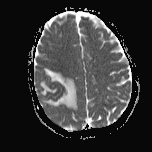 File:Cerebral venous infarction - hemorrhagic (Radiopaedia 81625-95505 Axial ADC 16).jpg