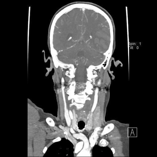 File:Cerebral venous infarction with hemorrhage (Radiopaedia 65343-74396 B 193).jpg