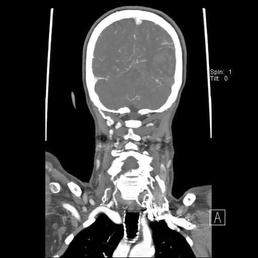 Cerebral venous infarction with hemorrhage (Radiopaedia 65343-74396 B 213).jpg