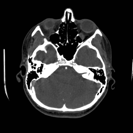 Cerebral venous sinus thrombosis (Radiopaedia 40619-43227 A 55).jpg