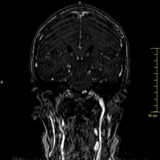 File:Cerebral venous thrombosis (Radiopaedia 23288-23351 MRV 90).JPG