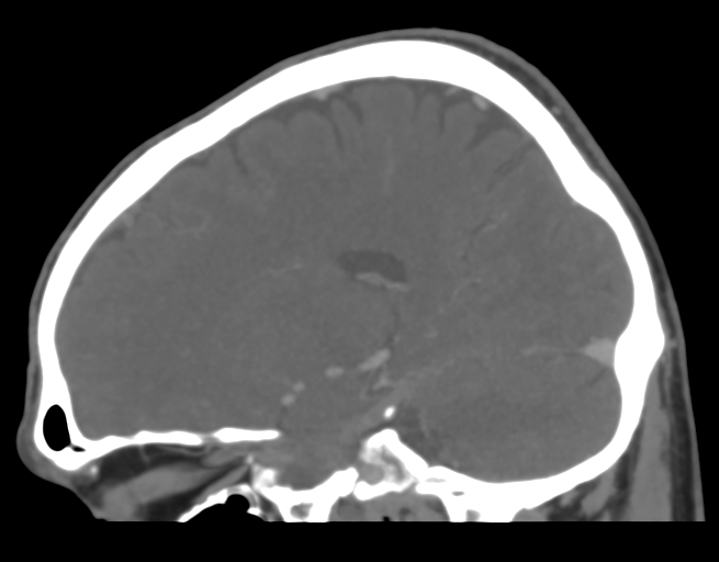 Cerebral venous thrombosis (Radiopaedia 38392-40467 D 33).png