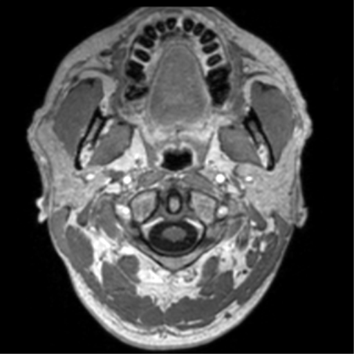 Cerebral venous thrombosis (Radiopaedia 38392-40469 Axial T1 C+ 1).png
