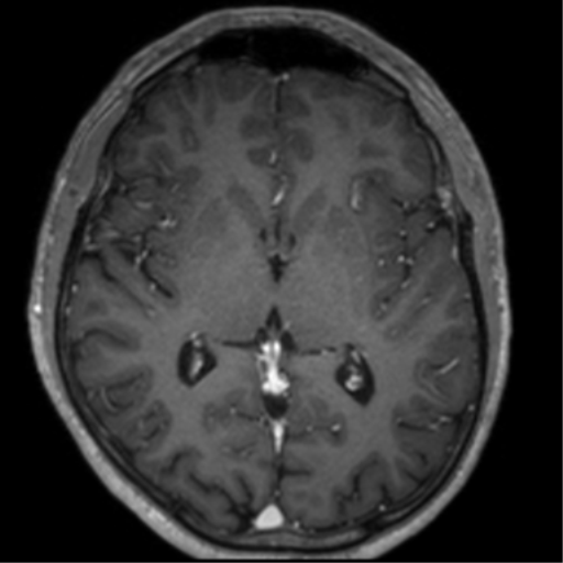 Cerebral venous thrombosis (Radiopaedia 38392-40469 Axial T1 C+ 42).png