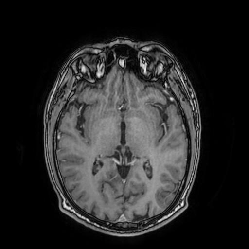 File:Cerebral venous thrombosis with secondary intracranial hypertension (Radiopaedia 89842-106957 Axial T1 C+ 93).jpg