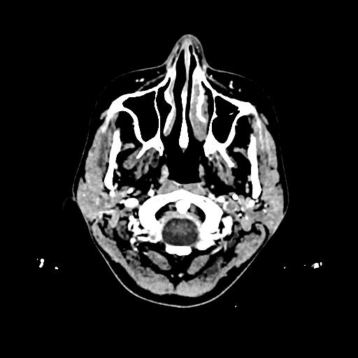 Cerebral venous thrombosis with venous hemorrhagic infarct (Radiopaedia 90354-107660 Axial with contrast 3).jpg