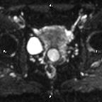 Cervical adenocarcinoma (Radiopaedia 65011-73985 Axial DWI 43).jpg