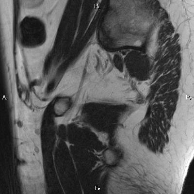 File:Cervical adenocarcinoma (Radiopaedia 65011-73985 Sagittal T2 3).jpg