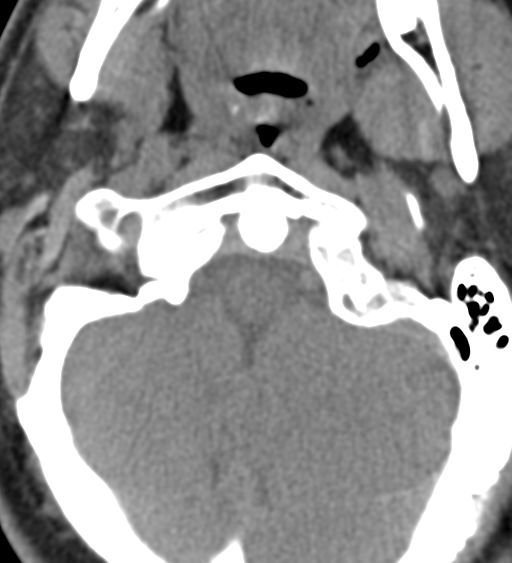 File:Cervical canal stenosis - OPLL and osteophytes (Radiopaedia 47329-51910 Axial non-contrast 10).png