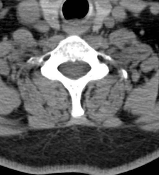 Cervical canal stenosis due to ossification of the posterior longitudinal ligament (Radiopaedia 47260-51823 Axial non-contrast 47).png
