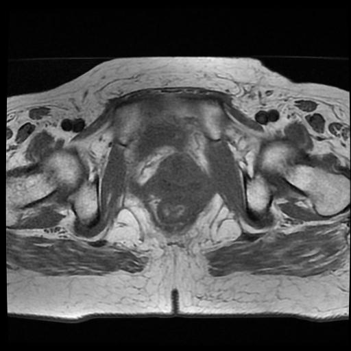 File:Cervical carcinoma (Radiopaedia 70924-81132 Axial T1 15).jpg