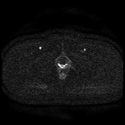 File:Cervical carcinoma (Radiopaedia 85405-101028 Axial DWI 41).jpg