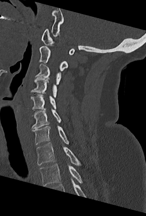 Cervical spine ACDF loosening (Radiopaedia 48998-54070 Sagittal bone window 51).png