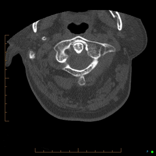 Cervical spine fracture - ankylosing spondylitis (Radiopaedia 76835-88706 Axial bone window 30).jpg