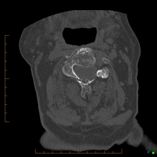 Cervical spine fracture - ankylosing spondylitis (Radiopaedia 76835-88706 Axial bone window 88).jpg
