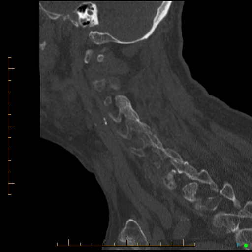Cervical spine fracture - ankylosing spondylitis (Radiopaedia 76835-88706 Sagittal bone window 34).jpg