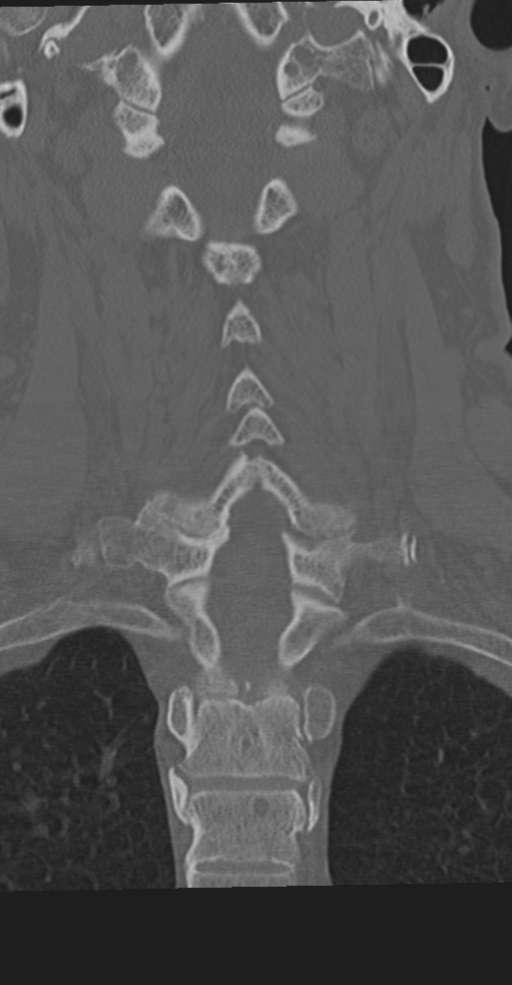 Cervical spine fracture in the setting of ankylosis (Radiopaedia 37038-38715 Coronal bone window 43).png