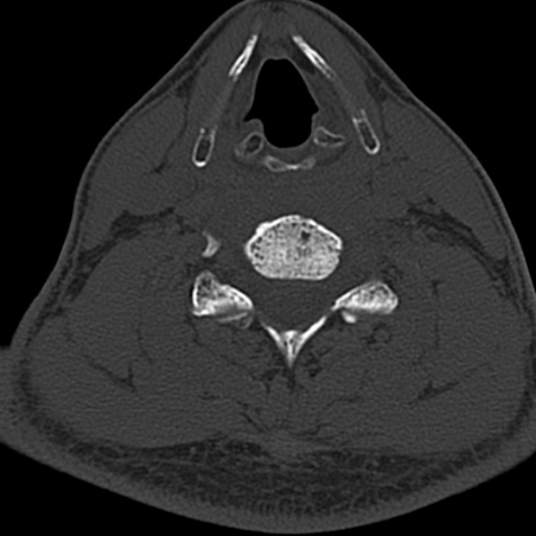 Cervical spondylodiscitis (Radiopaedia 28057-29489 Axial bone window 49).jpg