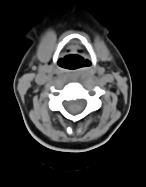 Cervical tuberculous spondylitis (Radiopaedia 39149-41365 Axial non-contrast 21).png