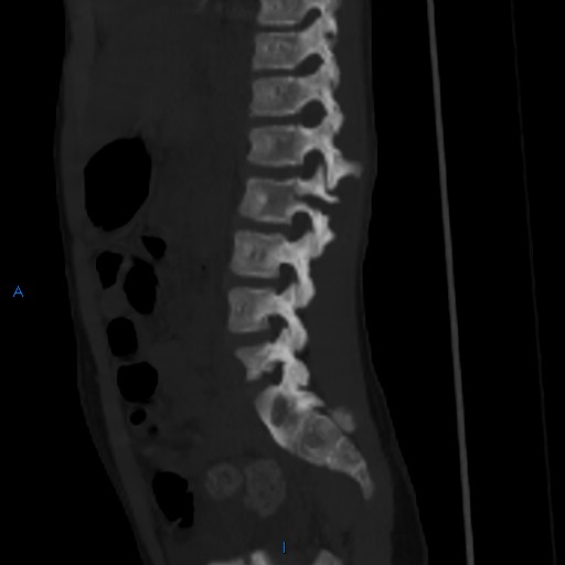 File:Chance fracture with duodenal and pancreatic lacerations (Radiopaedia 43477-50042 Sagittal bone window 6).jpg