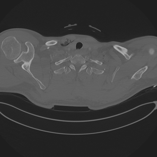 File:Chest multitrauma - aortic injury (Radiopaedia 34708-36147 Axial bone window 14).png