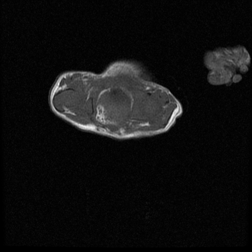 File:Chiari II malformation with spinal meningomyelocele (Radiopaedia 23550-23652 Axial T1 19).jpg