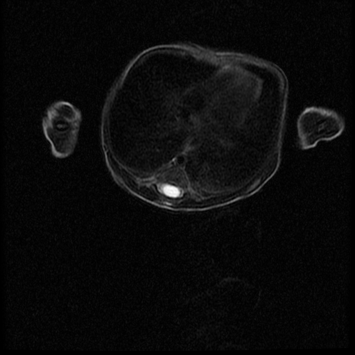 File:Chiari II malformation with spinal meningomyelocele (Radiopaedia 23550-23652 Axial T2 6).jpg