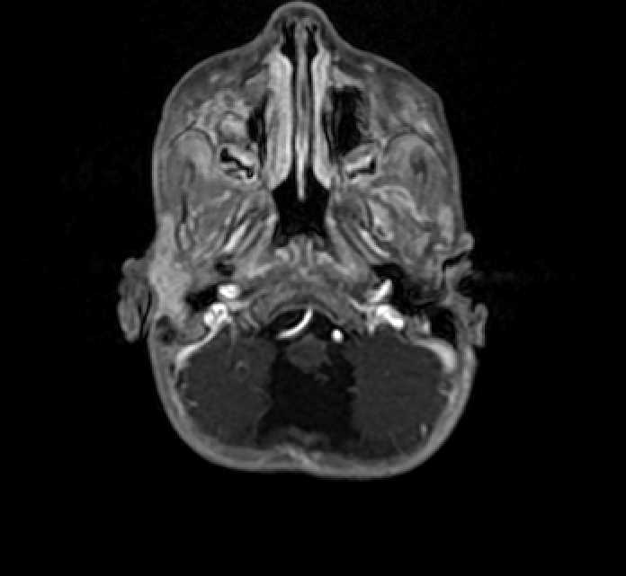 Chiasmatic-hypothalamic glioma (Radiopaedia 90079-107252 Axial T1 C+ 7).jpg