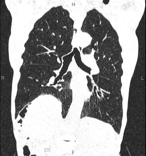 Chilaiditi sign (Radiopaedia 88839-105611 Coronal lung window 37).jpg